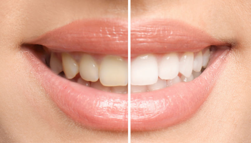 before and after procedure teeth whitening in dresher, pa